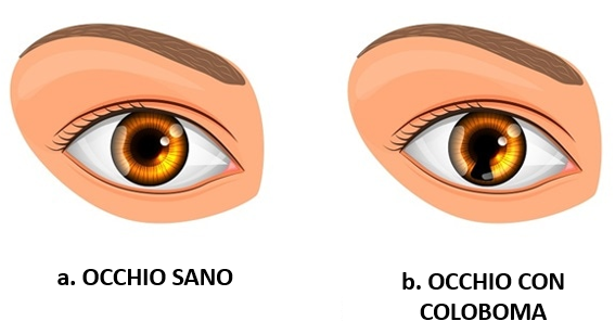 Sindrome degli Occhi di Gatto, come si manifesta - Ability Channel